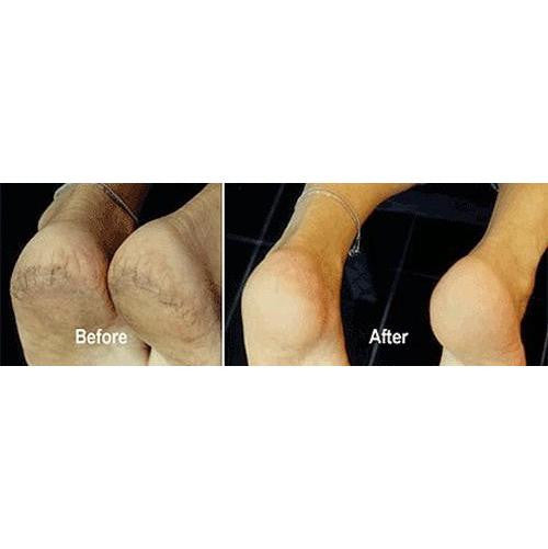 ProLinc Be Natural Callus Eliminator Foot Treatment 4oz - #1 Best Callus Remover